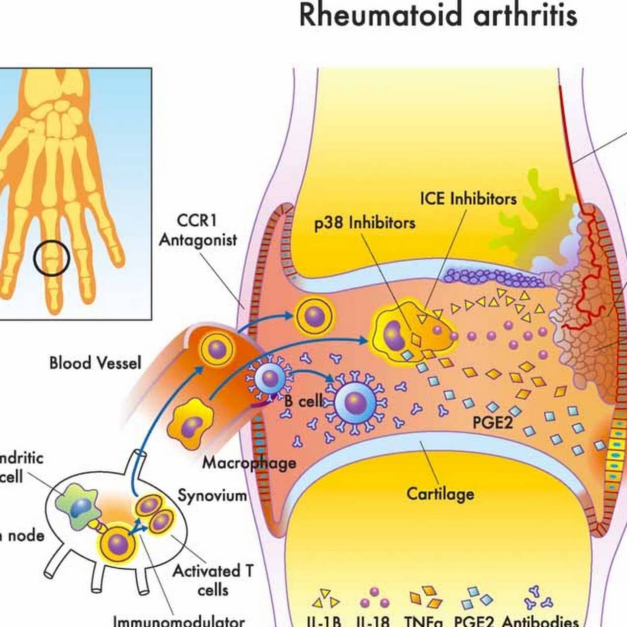 Rheumatoid Arthritis Diagram Rheumatoid Arthritis Diagram